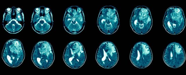 The Deadliest Kind of Brain Cancer May Have a Promising New Treatment