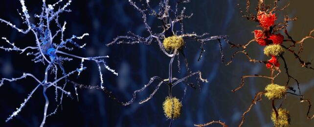 Brain Autopsies Reveal a Potential New Culprit Behind Alzheimer's