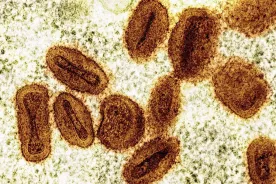 1st U.S. case of severe mpox strain confirmed in traveller: health officials