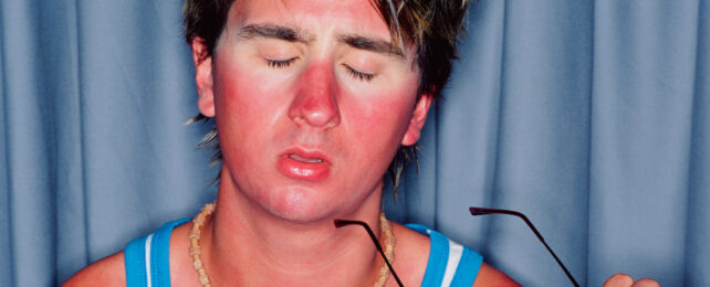 We've Been Wrong About What Causes Sunburn, Scientists Discover