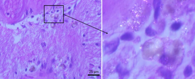 Microplastics Could Accumulate in Our Brains More Than in Kidneys And Livers