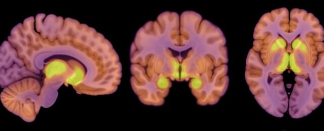 Anorexia Patients Reveal a Distinct Pattern in Their Brain Activity