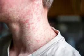 Measles is making a comeback in Canada. What’s driving the surge?