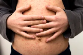 Another travel-related case of measles reported in Metro Vancouver